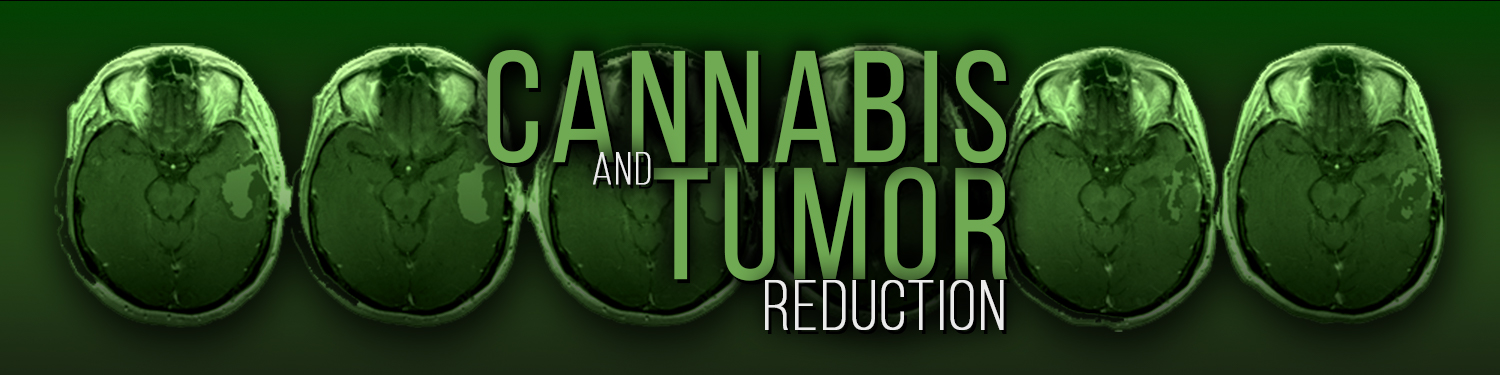Potential Benefits of Cannabidiol in Cancer Care